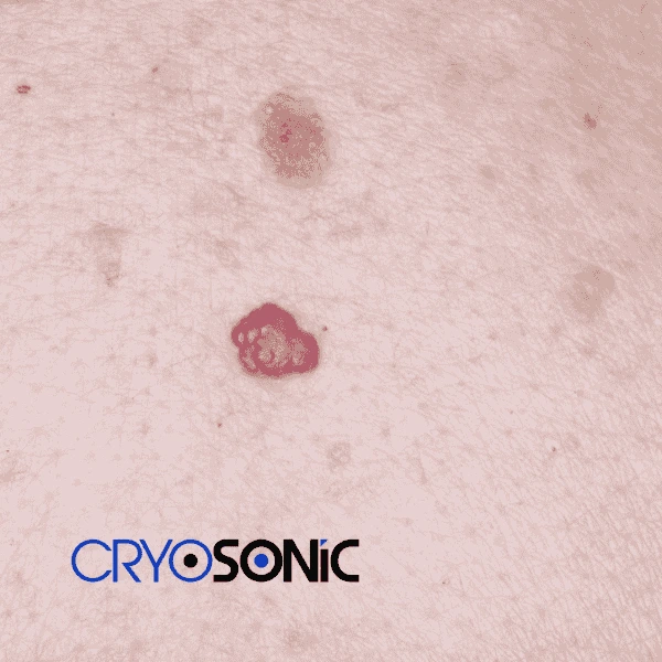 Looking for pain free cherry angioma removal treatment Barking? Call our team today! Barking