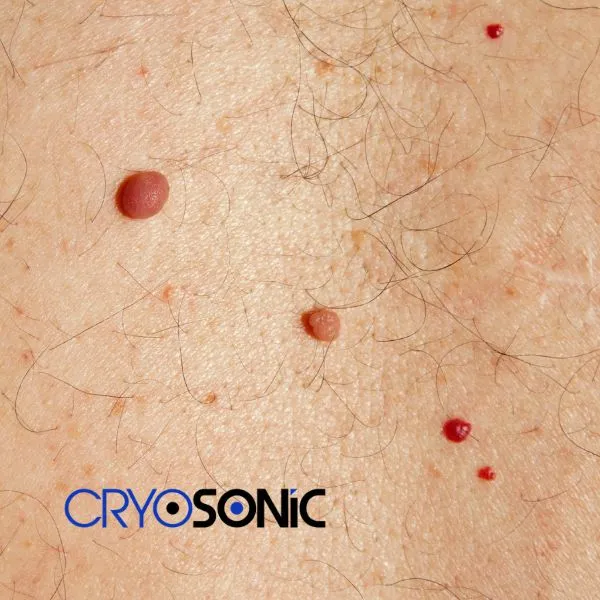 get cherry angioma removal treatment today! Barking
