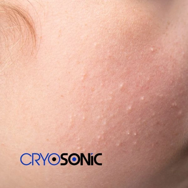 Are you looking for milia removal treatment? Contact our team today Barking