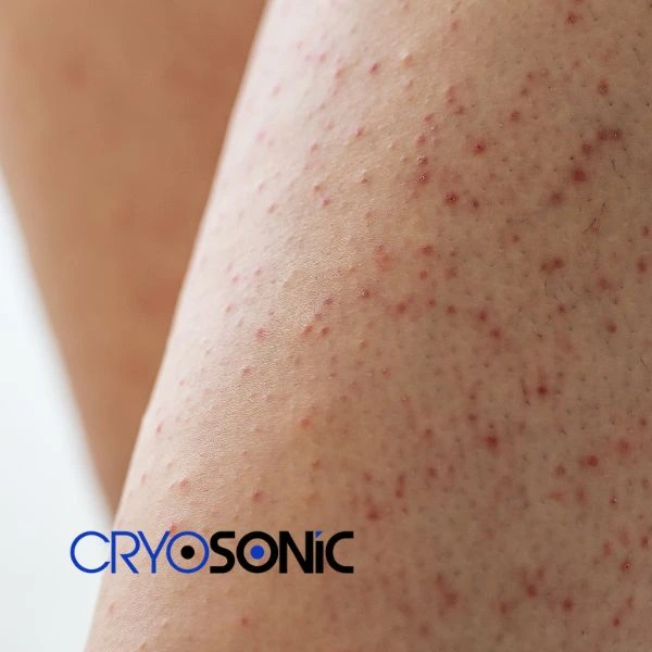 Looking for Seborrhoeic Keratosis removal Barking treatment? Call our consultants today in Barking