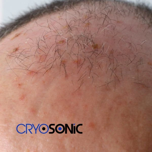 Access Seborrhoeic Keratosis removal from the comfort of your own home! Call us today in Barking