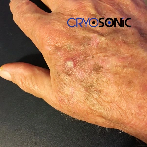 Understand more about actinic keratosis treatment today Barking