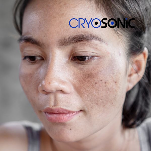 Ready to start age spots removal? Contact our team today in Barking