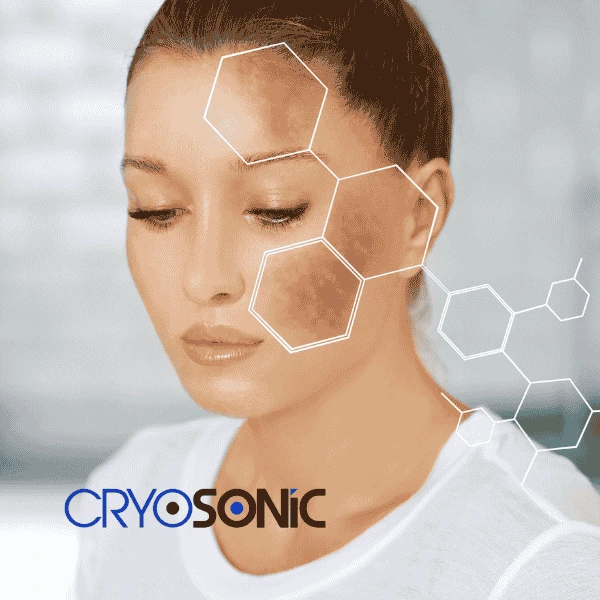 Are you looking for age spot removal treatment? Contact Cryosonic today in Barking