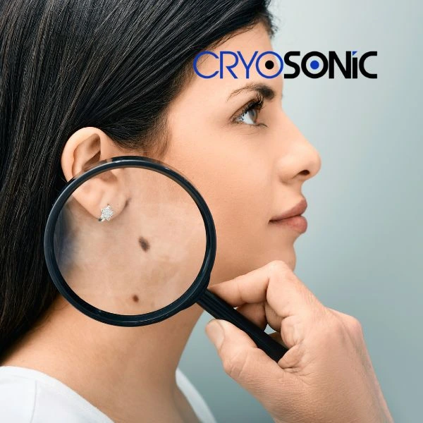 Do you want to learn more about benign moles removal treatment? Call our team today Barking