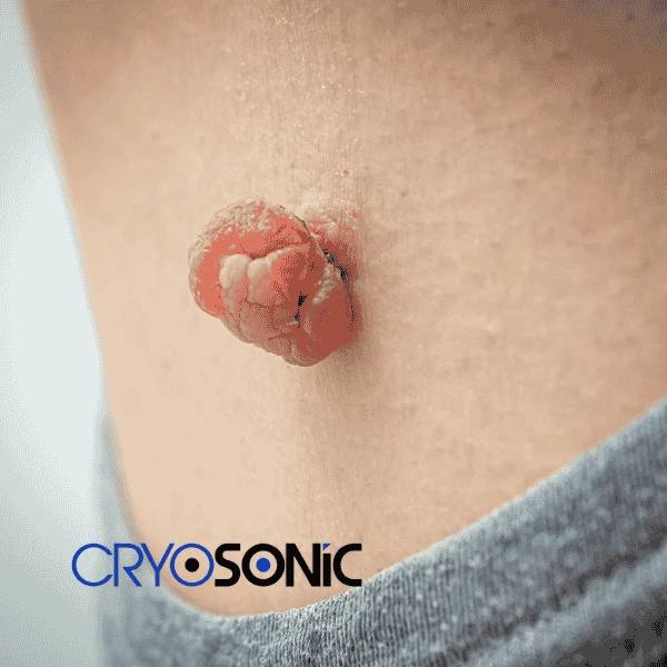 Book your skin tags removal Barking from comfort of your own home! Barking