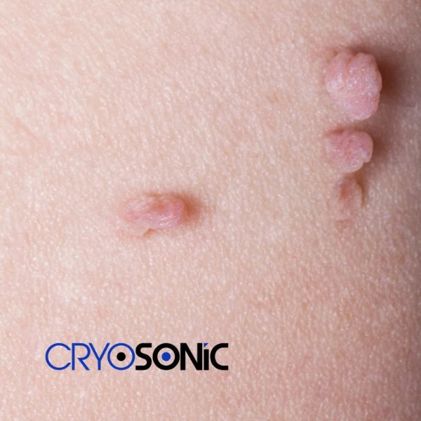 Are you looking for fast effect skin tag removal Barking? Book in NOW! Barking