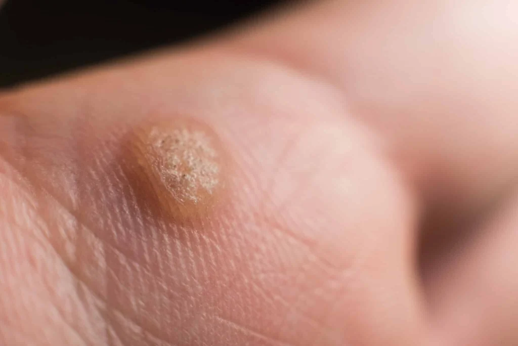 CryoPen treatment for Common Warts showing precise freezing of viral skin lesions for safe and effective removal Barking