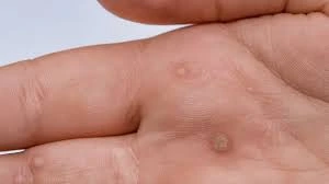 CryoPen treatment results showing smooth skin after Common Warts Barking removal with reduced risk of recurrence Barking
