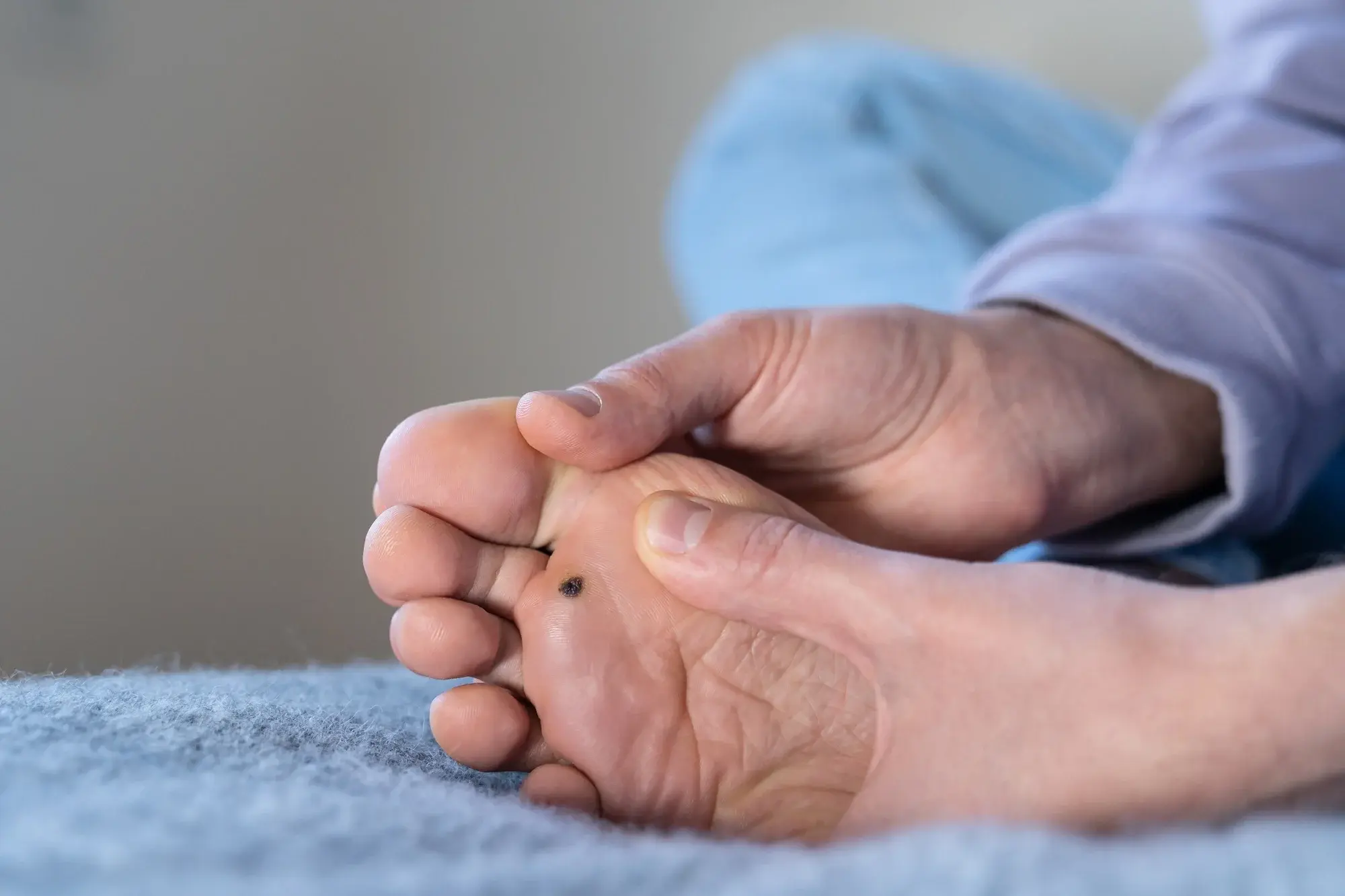 CryoPen treatment for multiple and stubborn Plantar Warts (Verrucae) Barking, showing safe, precise removal and patient-friendly procedure Barking