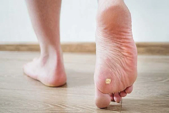 CryoPen treatment removing stubborn Plantar Warts (Verrucae) for precise, safe, and effective relief from resistant lesions Barking