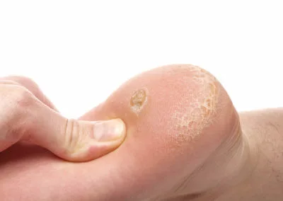 Painful Plantar Warts (Verrucae) Barking, highlighting how stubborn warts affect everyday activities and comfort Barking