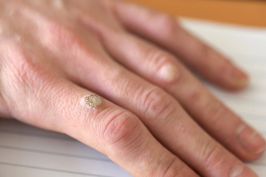 Patient considering removal of Common Warts Barking for cosmetic improvement, comfort, and hygiene with CryoPen treatment Barking