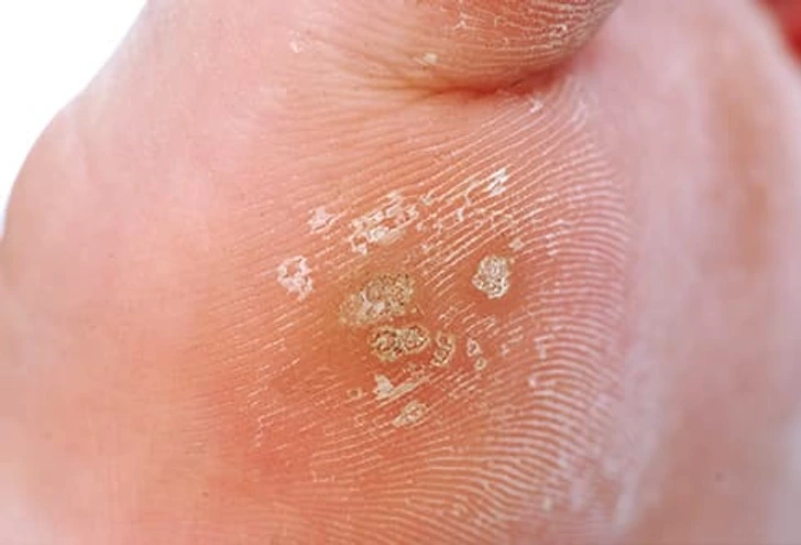 Close-up of Common Warts Barking on skin, showing small rough viral lesions typically caused by HPV infection Barking