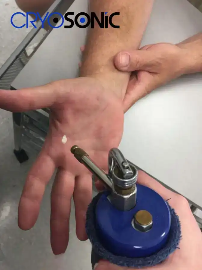 Temperature Differences: OTC vs Medical-Grade Cryotherapy Barking